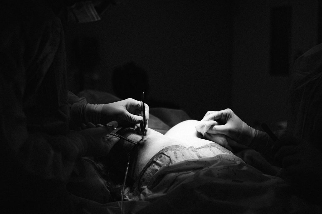 grayscale photo of a surgeon stitching a patient s breast